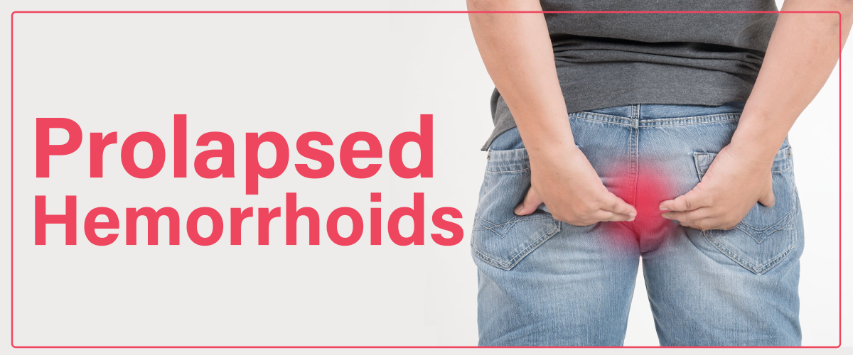 Prolapsed Hemorrhoids: Understanding The Symptoms, Causes, and Treatments